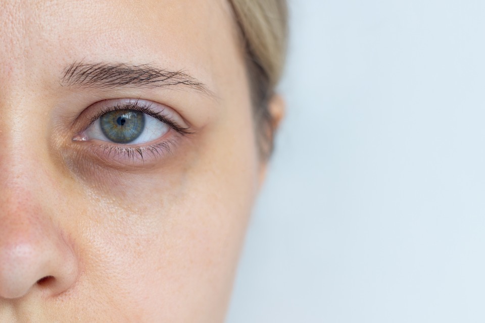 Kenali Sinyal Tubuh: Ciri-Ciri Umum Kekurangan Zat Besi